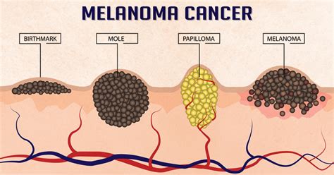 treatment for melanoma skin cancer